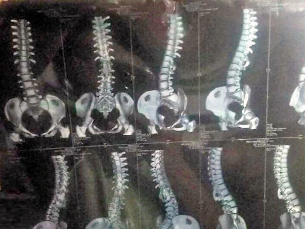 Help Manjula to undergo Backbone Surgery