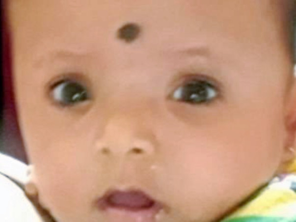 Help Prapti fight from Bicoronal Synostosis