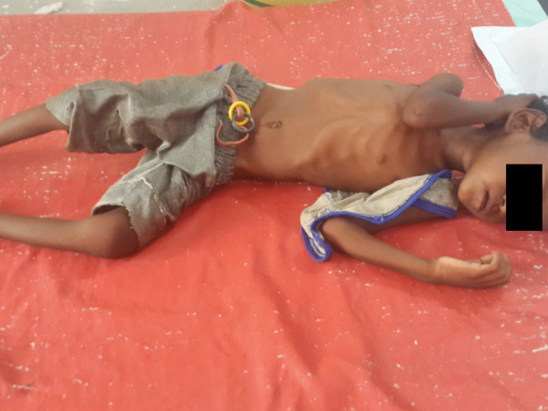 Save the lives of severely malnourished children in Bihar
