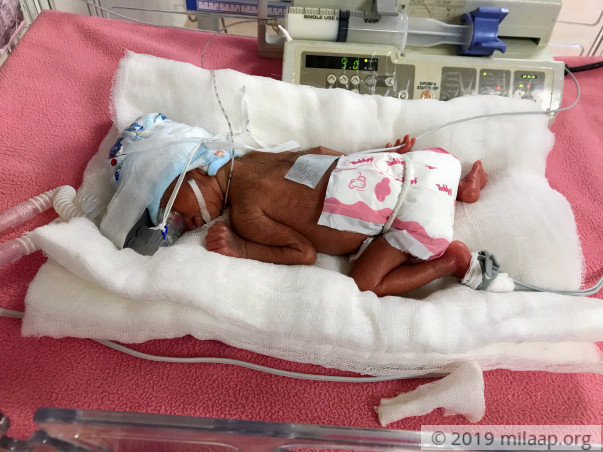 Help Shamika and Amogh's prematurely born baby recover soon