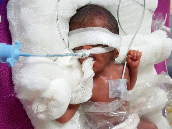 Extreme Premature Baby Fight Respiratory Distress