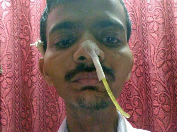 Chandrakant Rasal- Tongue Cancer