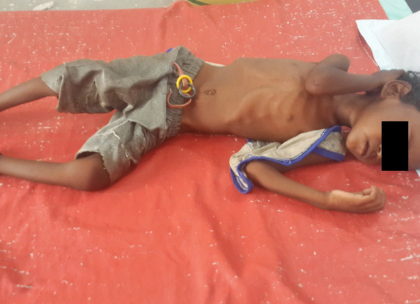 Save the lives of severely malnourished children in Bihar