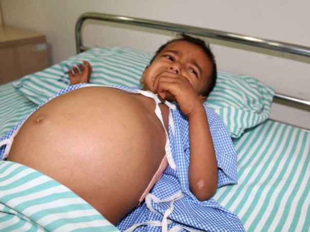 Baby's Stomach Has Swollen To The Size Of A Football Because Of Cancer