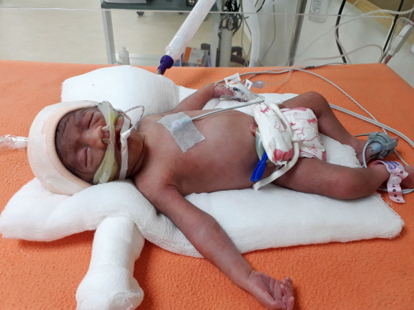Fisherman Who Lost One Twin Before Birth Needs Help To Save The Other