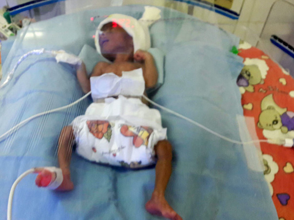 Help my premature Baby