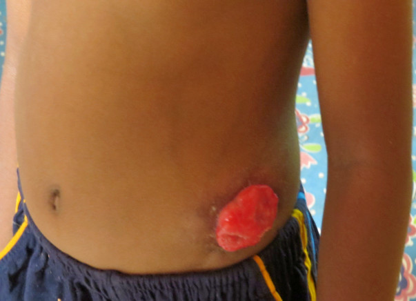 Help for 5 year old Divesh's Colostomy Closure Surgery