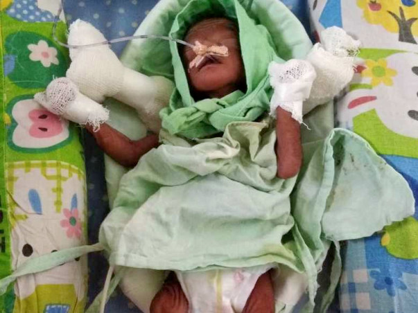 Help Shubhangi to Save 26 weeks Pre-mature Twins! (Only One Survived)
