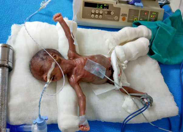 Please help my new born with 470 grams of weight at birth
