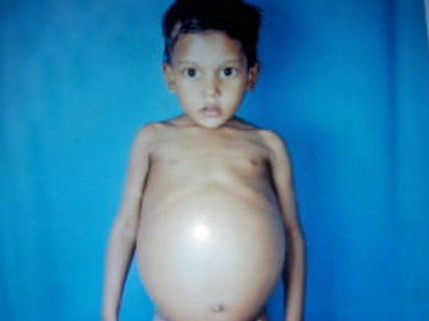 Help Joseph Raj From Gaucher Disease