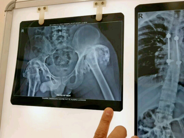 Help Karan Undergo Knee Surgery