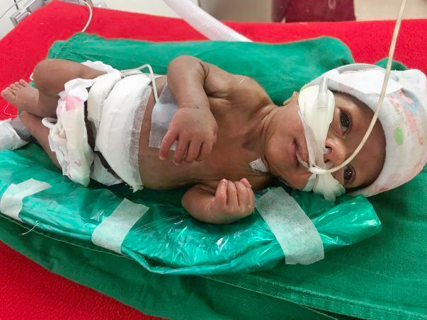 Help Vishakha and Vinayak save their premature baby boy