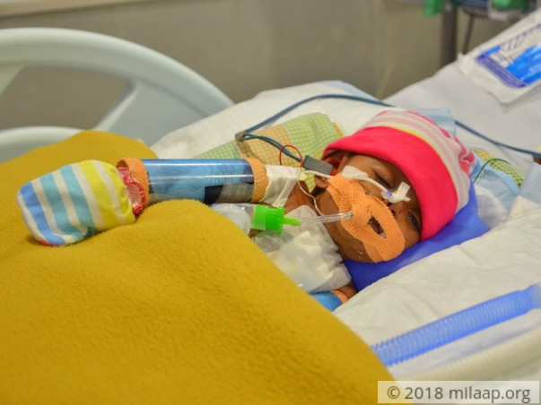 Help This Baby Girl Who Was Born Premature With 3 Holes In Her Heart