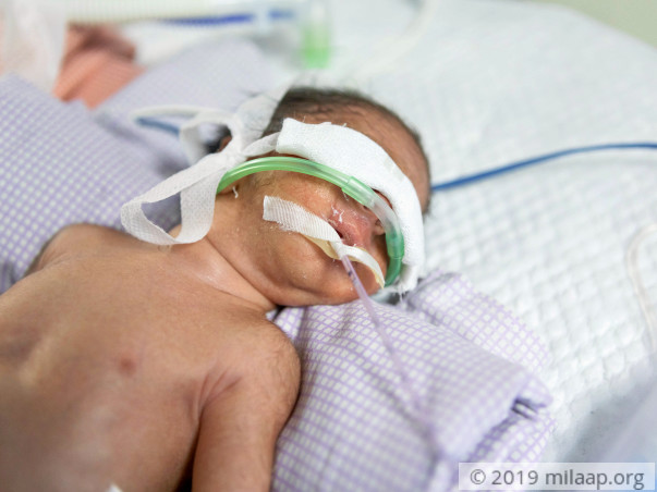 Baby of Arshiya needs your help to survive