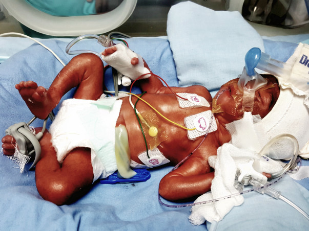 Help prematurely Born Baby Fighting For Life