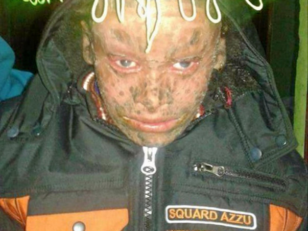 Help Prince Fight Rare Skin Disease