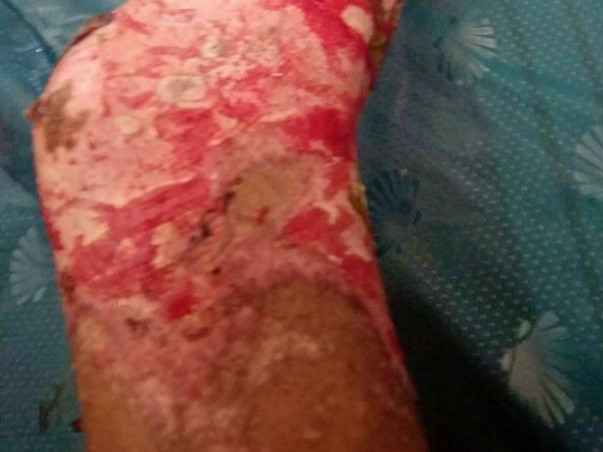 Help Nisha The Acid Victim