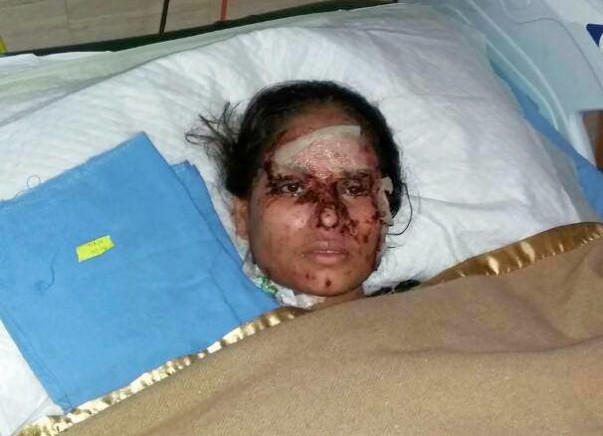 In Memory of Salma, Saving Relief Fund For Acute Acid Attack Cases