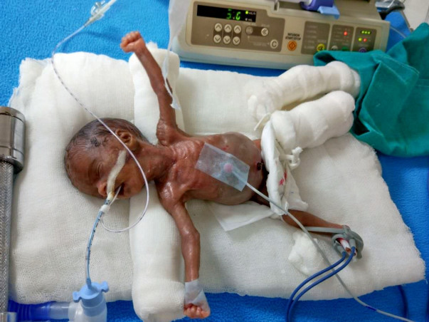 My Baby Weights 470 Grams And I Need Your Help To Save Her