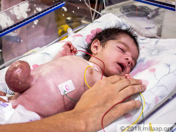 Baby Born With Intestine Outside His Body Has Only Few Hours Left