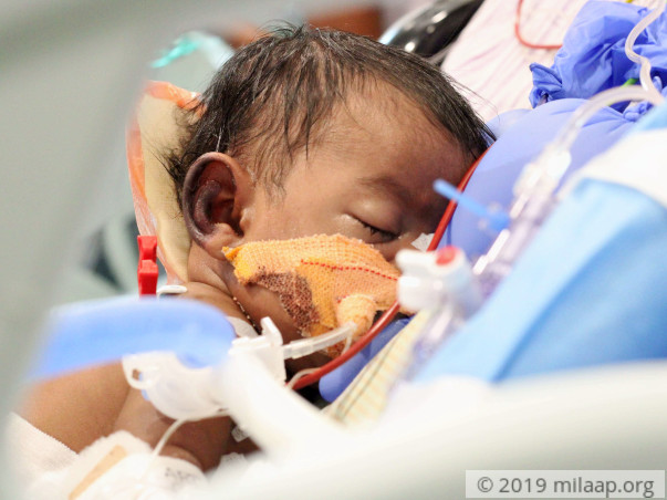 Despite Working Hard, Daily Wager Can't Save Baby From Heart Disease