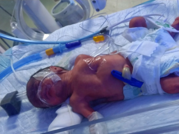 Please Save A Premature Baby, Now Struggling For Life In ICU!