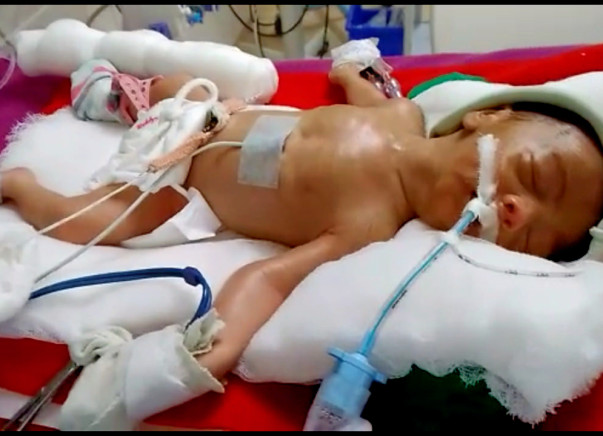 This premature-born is struggling and needs urgent help to survive