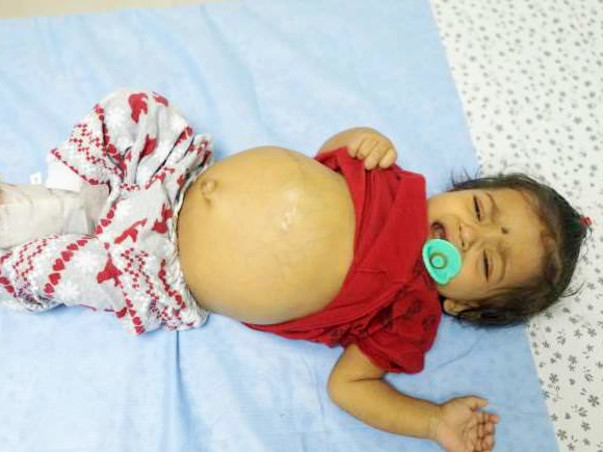 At the age of 9-months baby Pranavi has a serious liver disease
