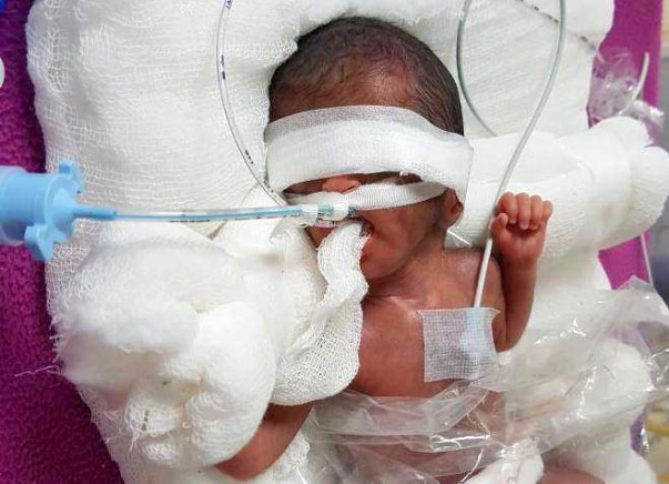 Extreme Premature Baby Fight Respiratory Distress