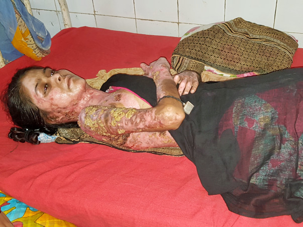 Help Juhi Who Had A Tragic Accident After the Gas Cylinder Burst.