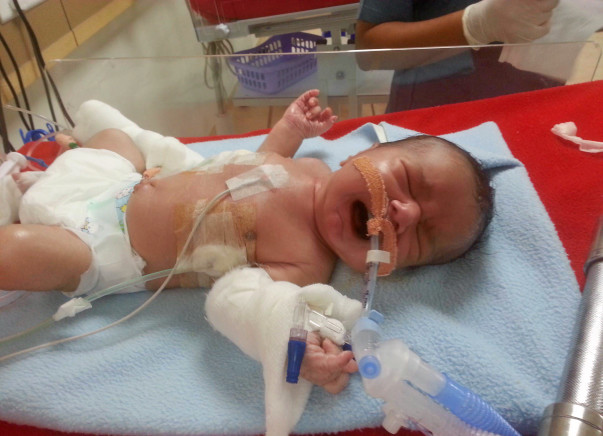 Help This Premature Baby Get Ventilator Support