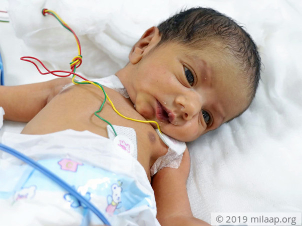 Help Baby of Naziya Undergo ASO + VSD Surgery Closure