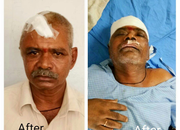Help for Y Muthyallu double brain hemorrhage operation