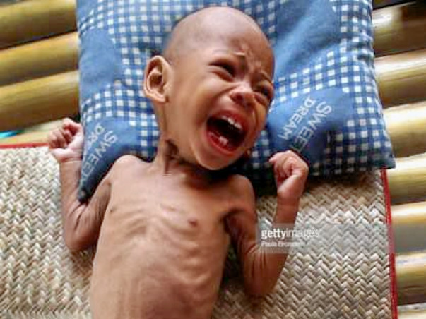 Help poor children to fight malnutrition