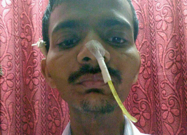 Chandrakant Rasal- Tongue Cancer