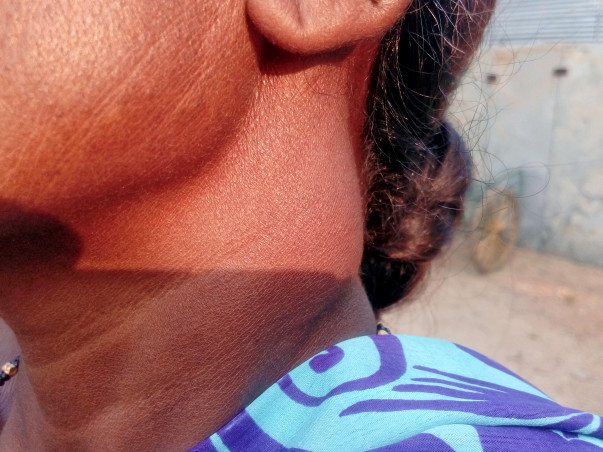 Help My Mother Fight Nasopharyngeal Cancer