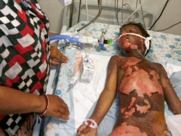 6 Year old kid Moiz Burnt Grievously in contact with high tension wire