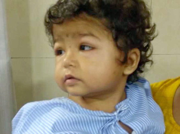 Help 2-year-Old Shraddha Fight Nephrotic Syndrome