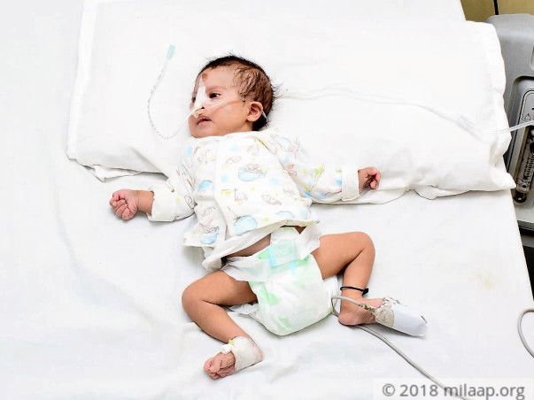 Baby Born With Down Syndrome Has A Serious Heart Defect, Needs Help