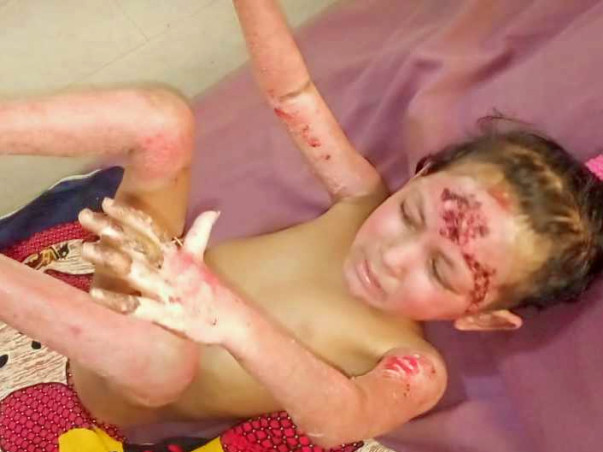 Help 7 Years Old Subhasmita Sahoo Fight Burn Due To GAS Cylinder Blast