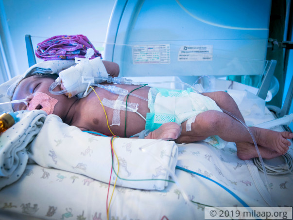 1-Month-Old Baby Who Struggles For Every Breath Needs Urgent Help