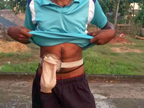 Help Pathivada Adinarayana undergo laparotomy reversal of ileostomy