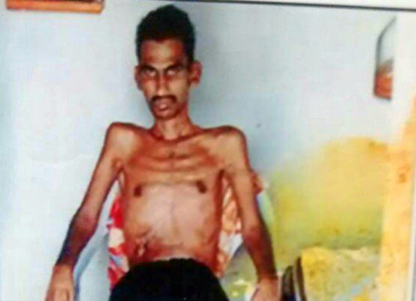 Help Mr Narasimha to fight back. He met with tragic accident lost limb