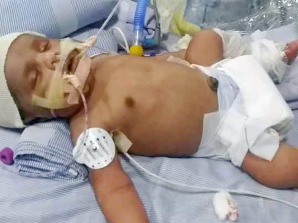 Help Me To Save My Baby. He Needs To Undergo Liver Transplant.