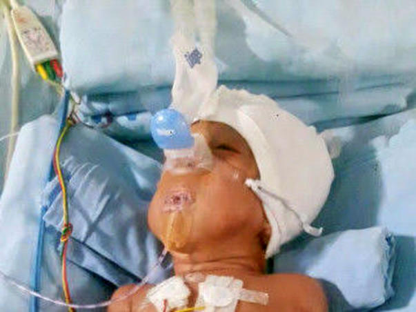 1 year old Diya needs your help for Liver transplant