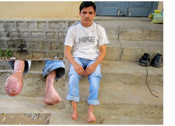 Help Feetless Yadagiri Buy Artificial Limbs