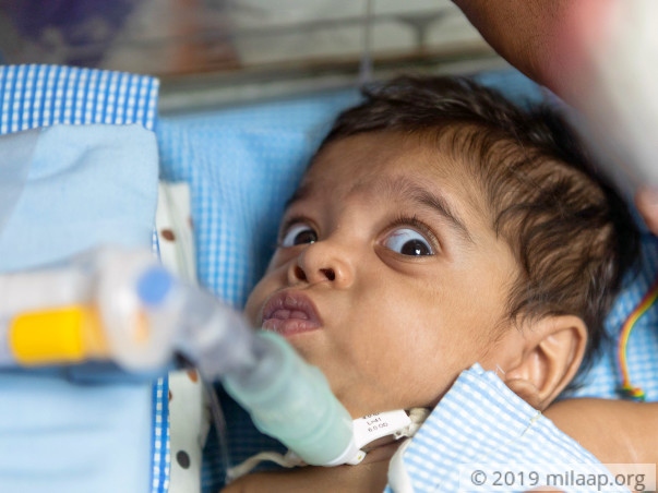 Father Lost Job While Trying To Save Baby, Needs Help To Treat Her