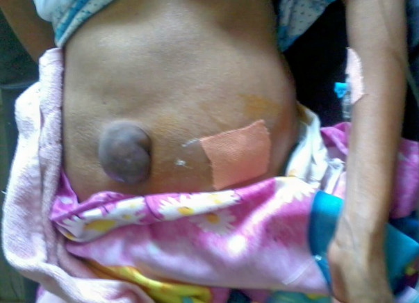 Mother's treatment liver cirrhosis