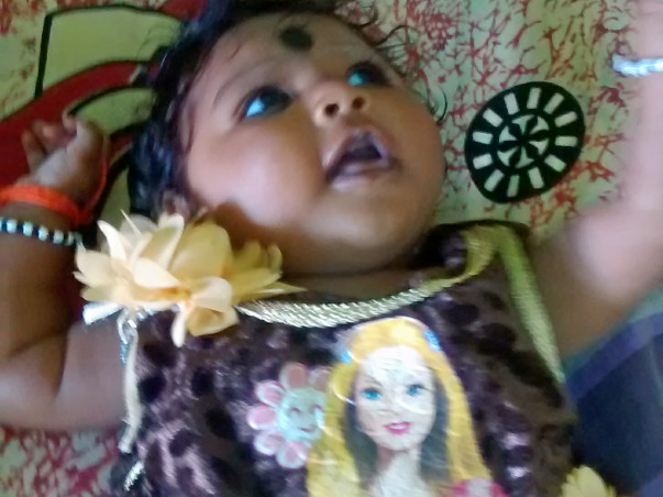 Baby suffering with "Microcephaly "