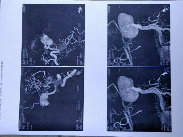 Need help for Brain hemorrhage patient